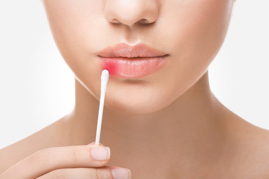 Opryszczka Przyczyny Objawy Leczenie Portal Kosmetologa