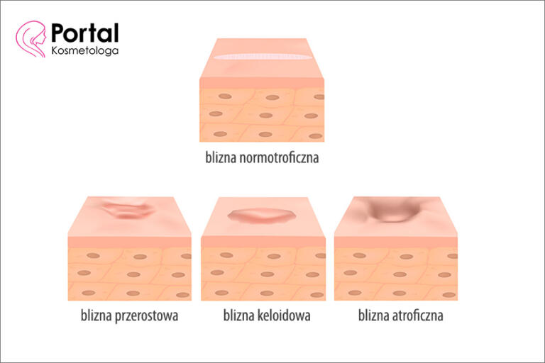 Tr Dzik Bliznowaty Portal Kosmetologa