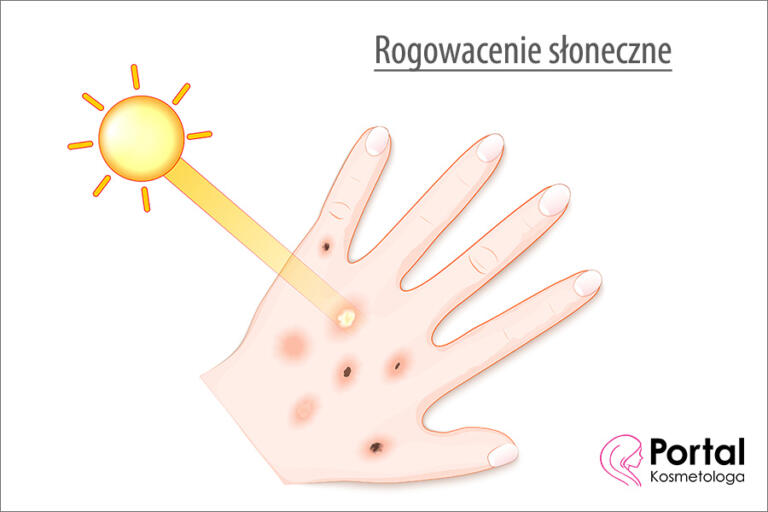 Rogowacenie słoneczne Portal Kosmetologa