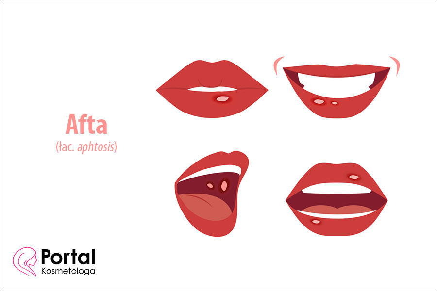 Afta