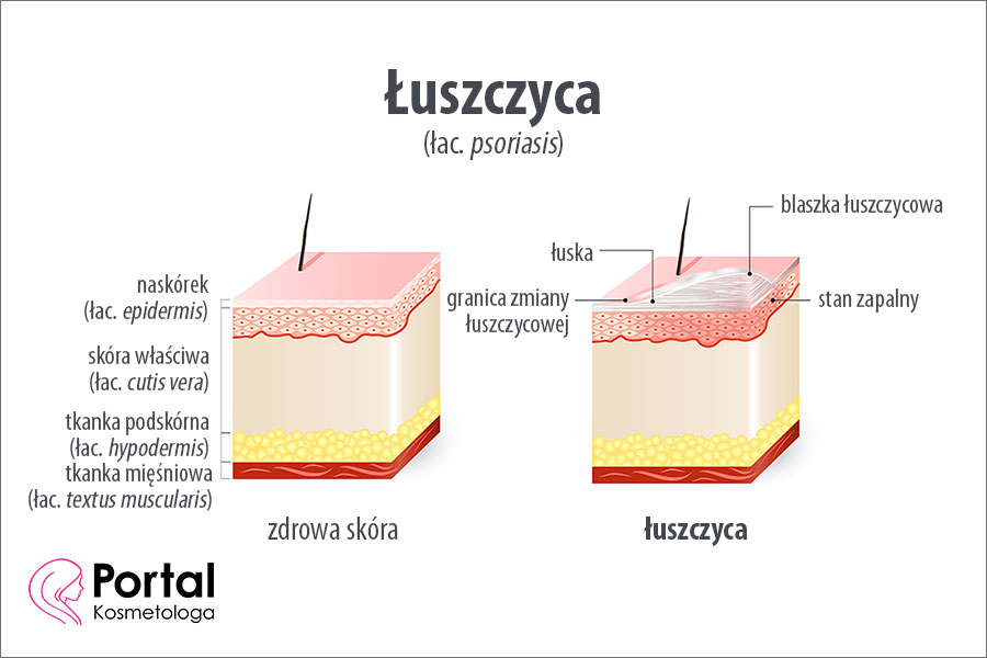 Łuszczyca