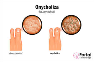 Onycholiza