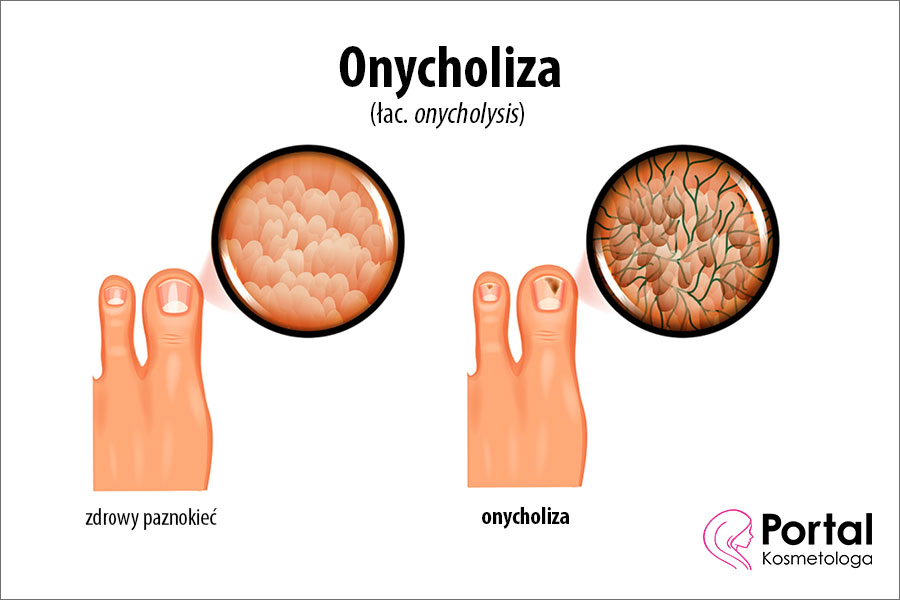 Onycholiza