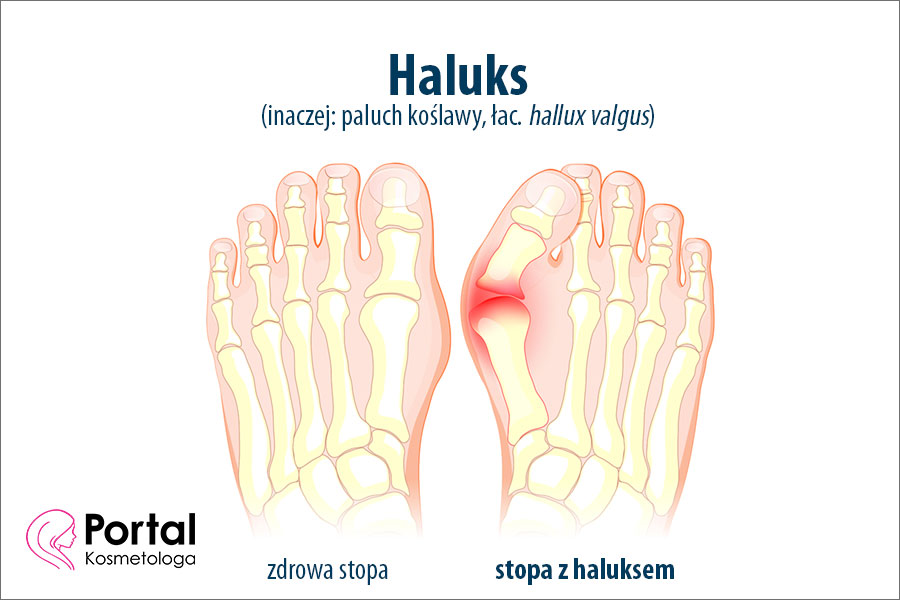 Haluks - czym jest i jak go leczyć?