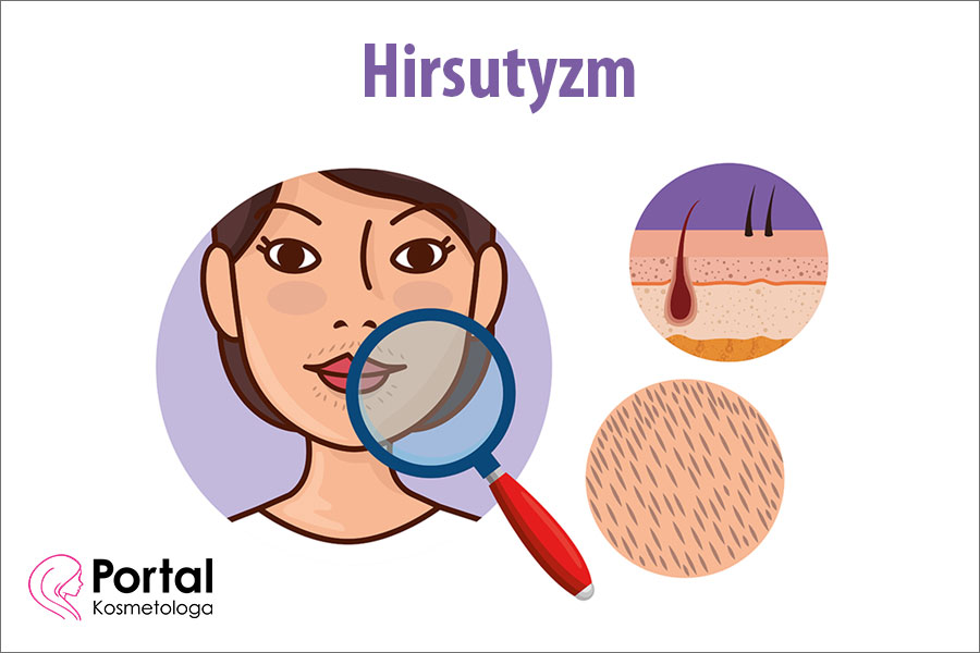 Hirsutyzm - przyczyny, objawy, leczenie