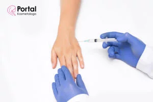 Skleroterapia - wszystko co warto wiedzieć