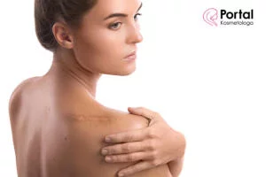 Leczenie bliznowców