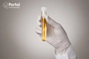 Badanie moczu - analiza