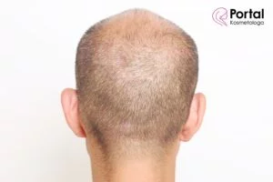 Łysienie u mężczyzn - przyczyny, objawy, leczenie