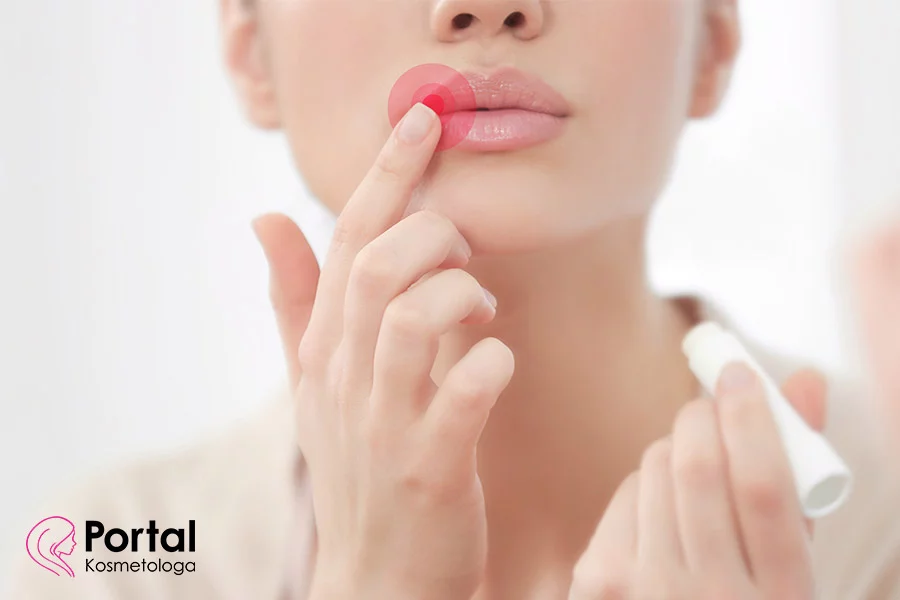 Zajady - przyczyny, objawy, leczenie