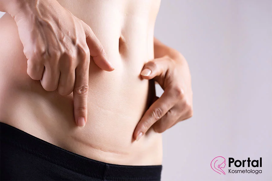 Blizna po cesarskim cięciu - jak o nią dbać?