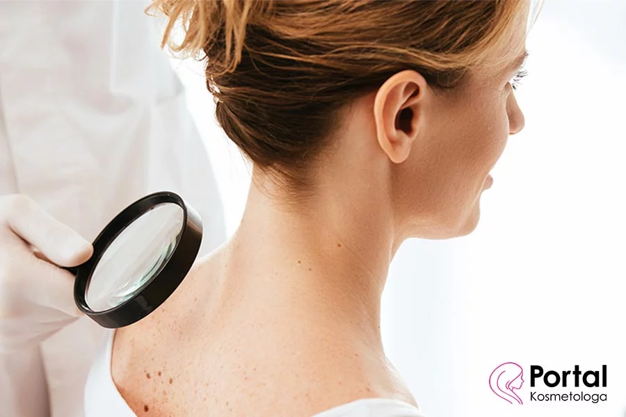 Róg skórny Róg skórny