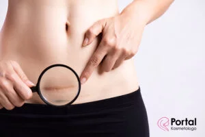 Fizjoterapia w leczeniu blizn