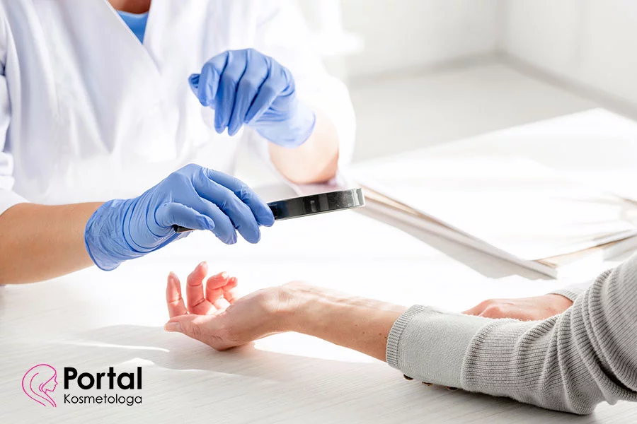 Liszaj płaski Liszaj płaski