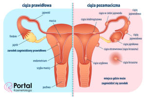 Ciąża pozamaciczna (ciąża ektopowa)