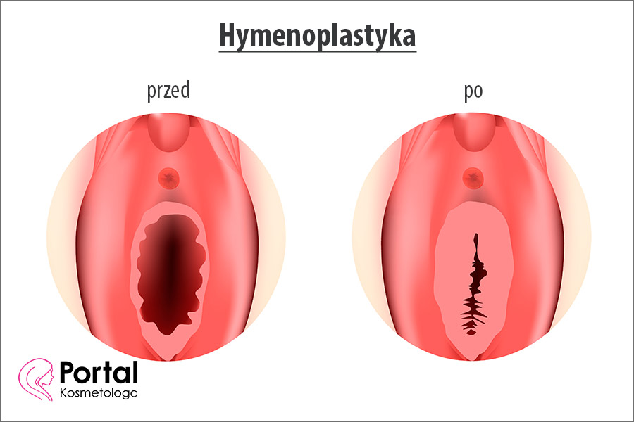 Hymenoplastyka