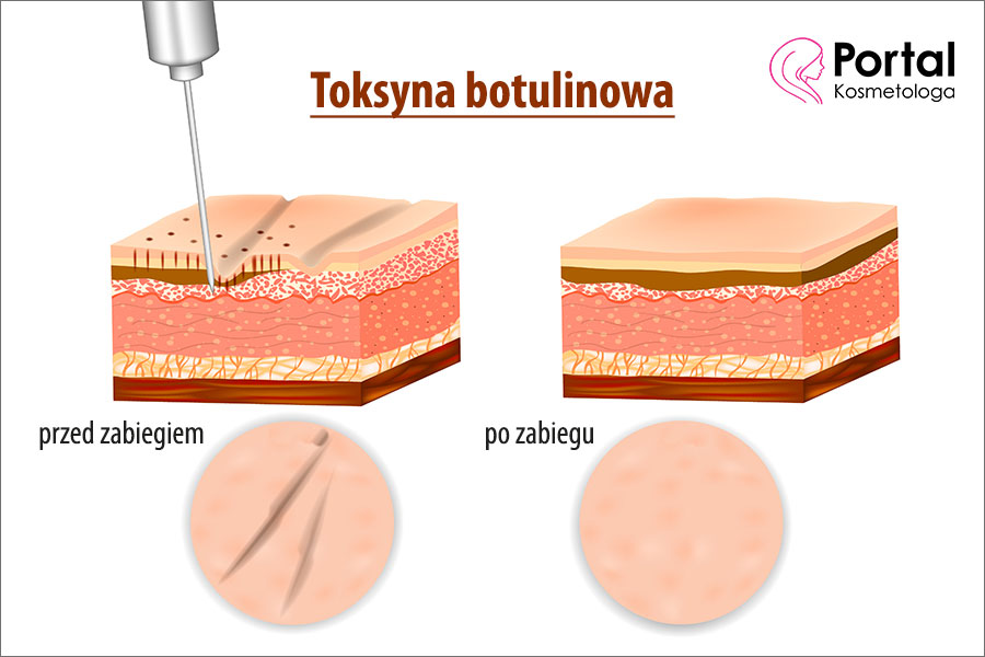 Toksyna Botulinowa Portal Kosmetologa 2787