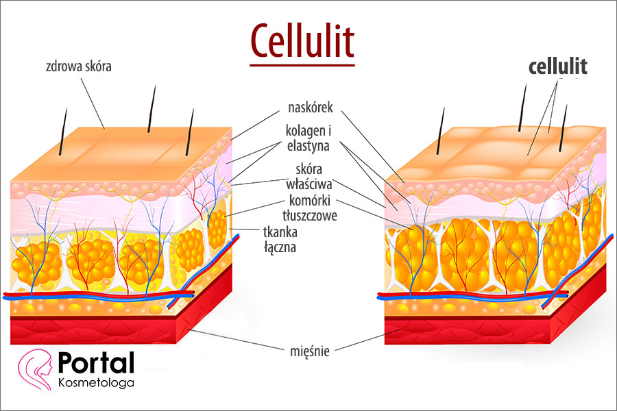 Cellulit