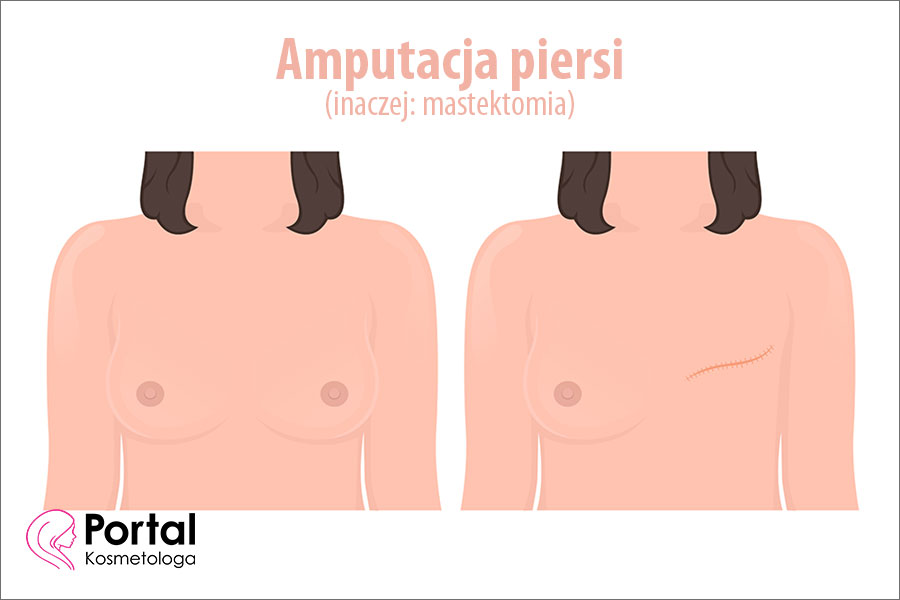 Amputacja piersi