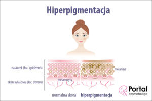Hiperpigmentacja