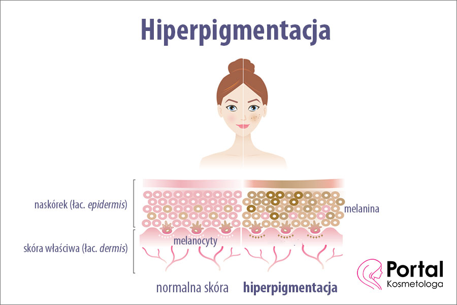 Hiperpigmentacja