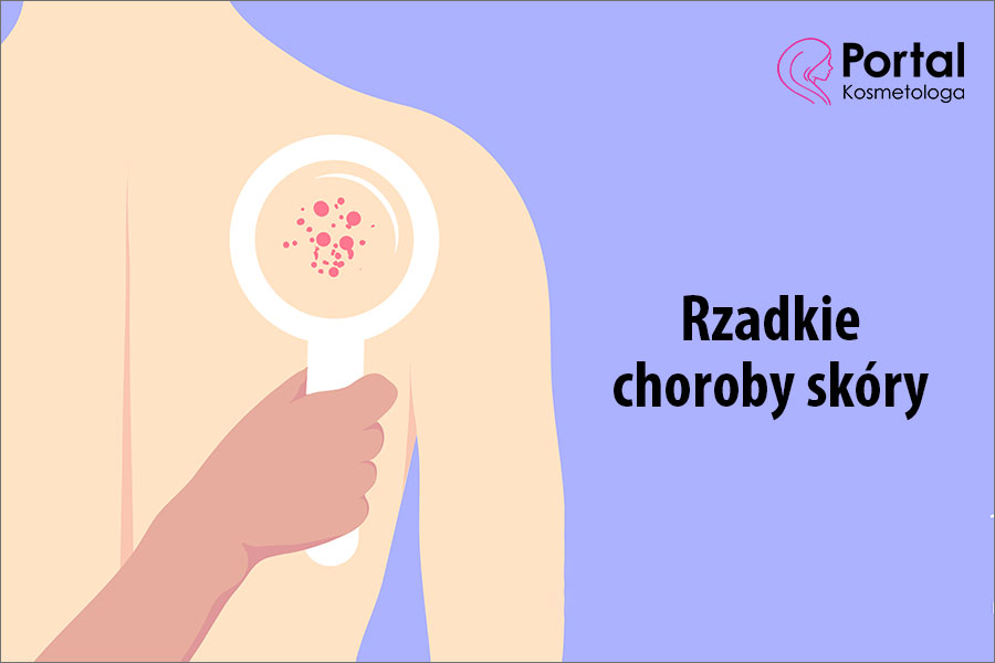 Rzadkie choroby skóry