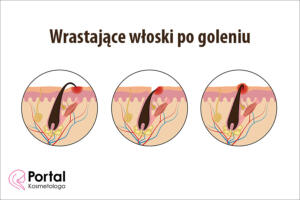 Wrastające włoski po goleniu