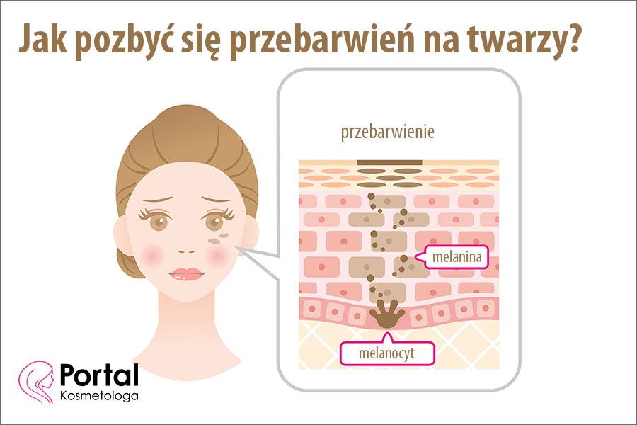 Jak pozbyć się przebarwień na twarzy?