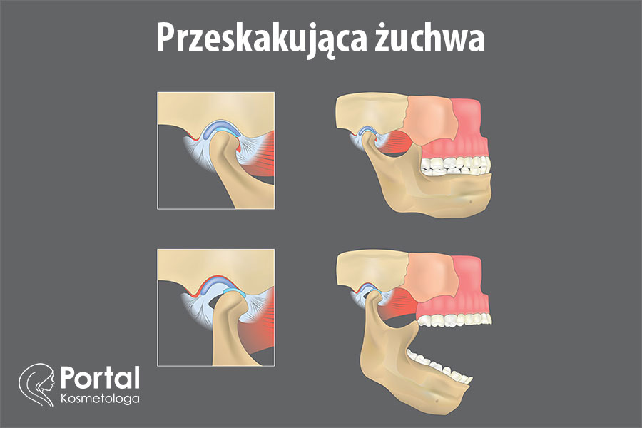 Przeskakująca żuchwa