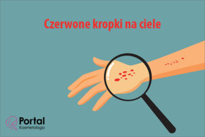 Czerwone kropki na ciele