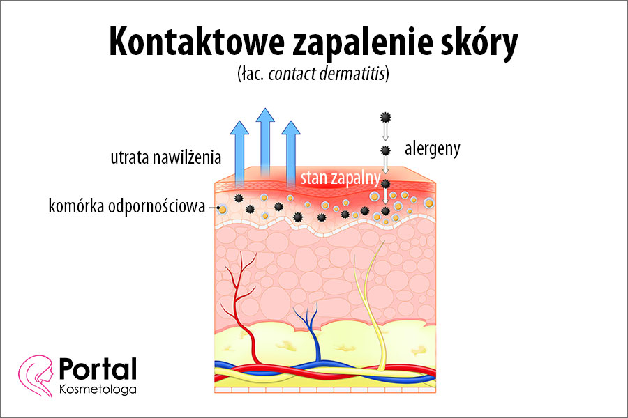 Kontaktowe zapalenie skóry