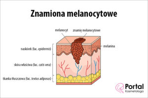 Znamiona melanocytowe