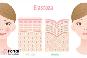 Elastoza