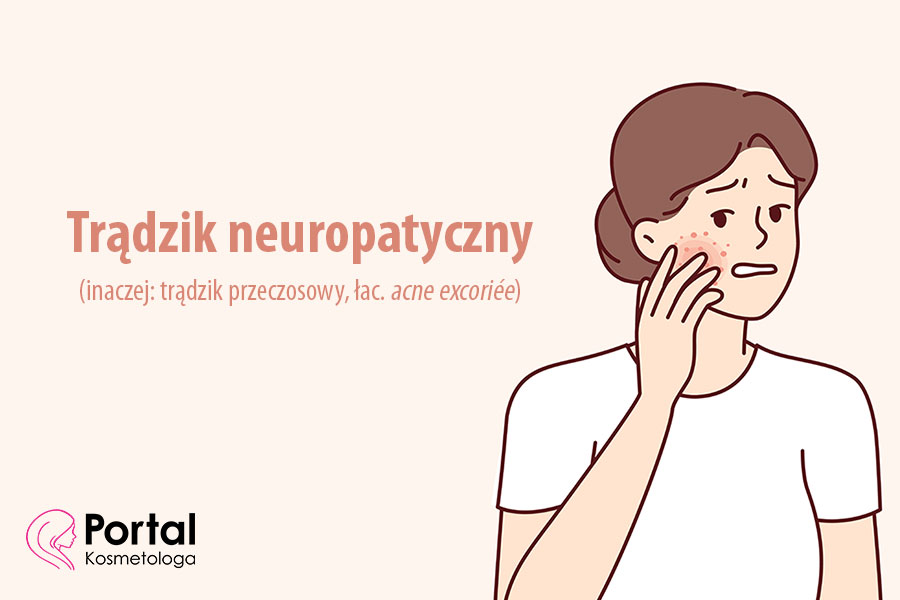 Trądzik neuropatyczny