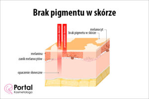 Brak pigmentu w skórze