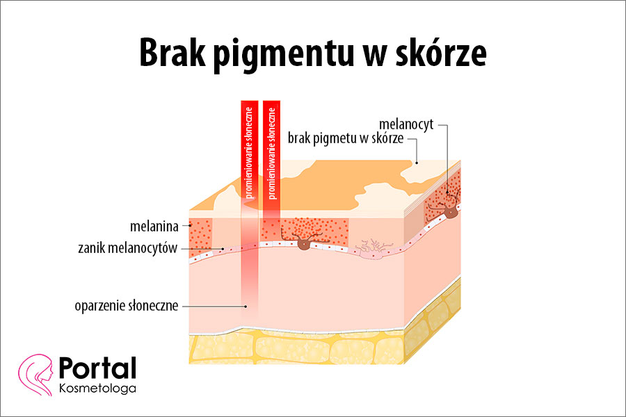 Brak pigmentu w skórze