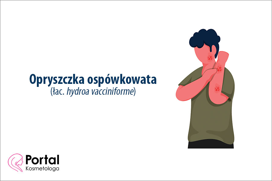 Opryszczka ospówkowata