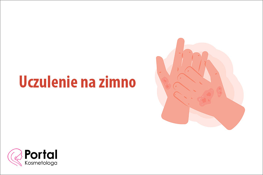 Uczulenie na zimno