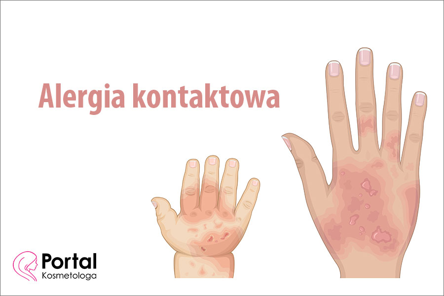 Alergia kontaktowa