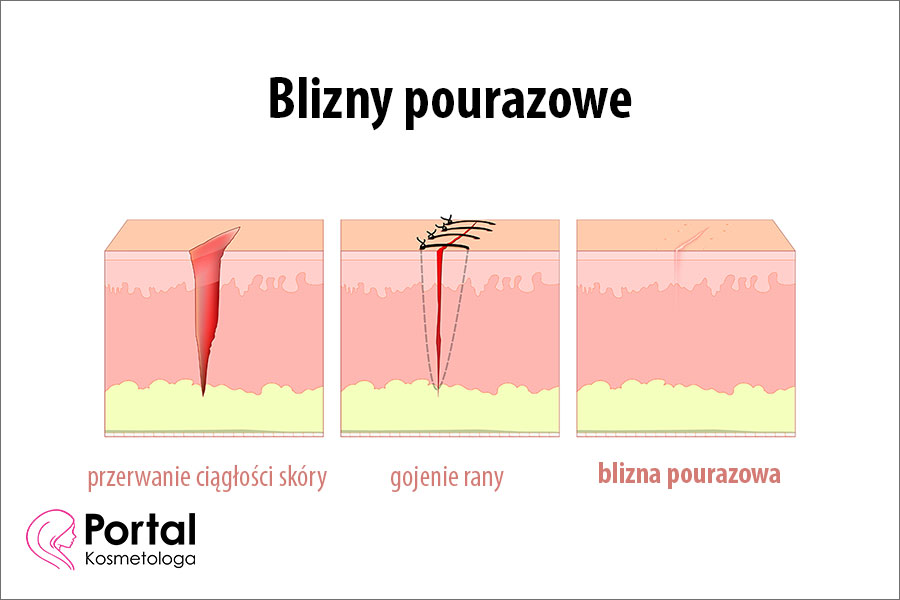 Blizny pourazowe