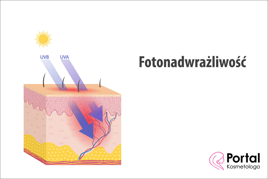 Fotonadwrażliwość