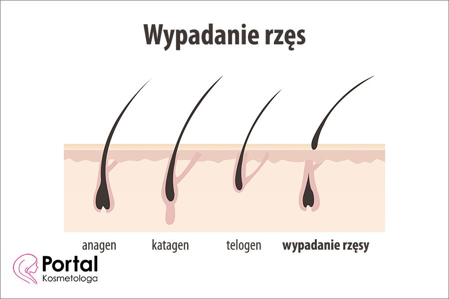 Wypadanie rzęs