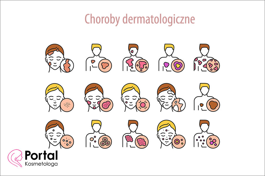 Choroby dermatologiczne