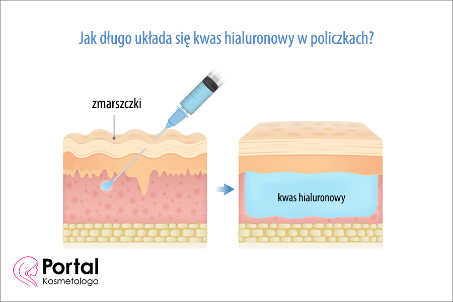 Jak długo układa się kwas hialuronowy w policzkach?