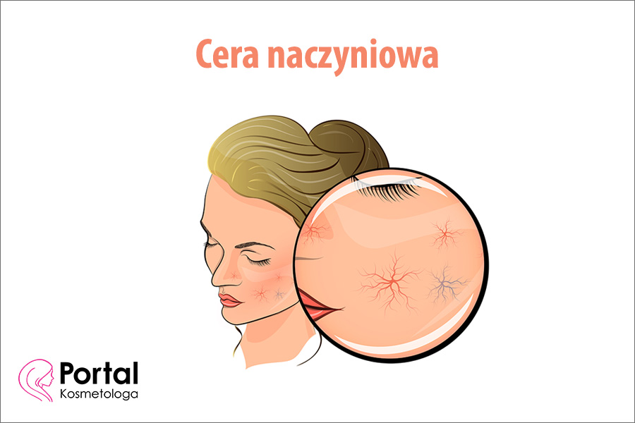 Cera naczyniowa