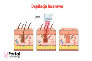 Depilacja laserowa