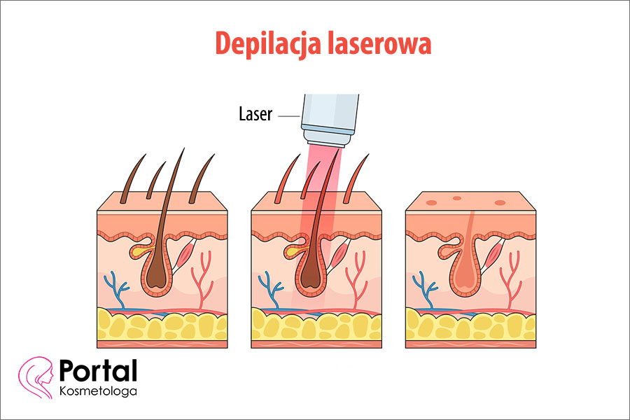 Depilacja laserowa