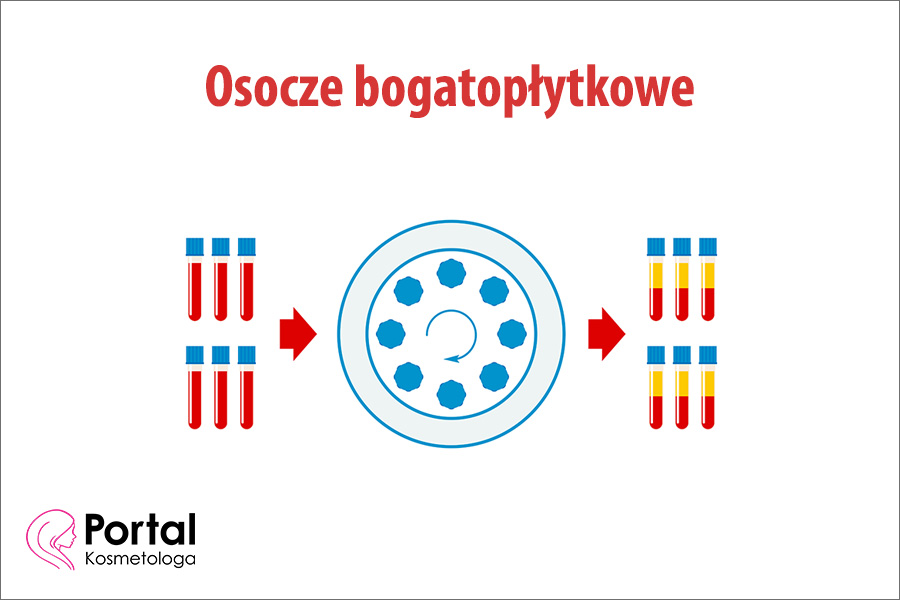 Osocze bogatopłytkowe