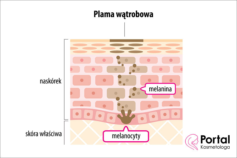 Plamy wątrobowe