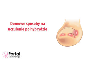 Domowe sposoby na uczulenie po hybrydzie